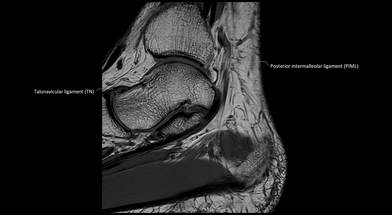 MRI ankle ligaments anatomy sagittal 3T image 9.webp